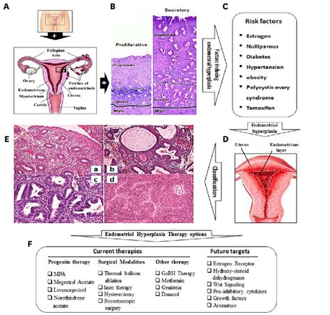 endometrial hyperplasia and endometriosis